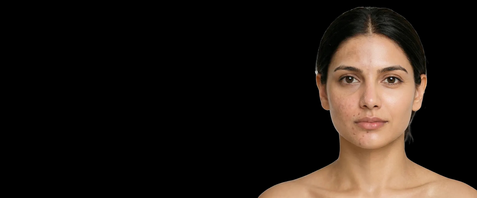 Woman showing skin transformation — dermatologist-led treatment results