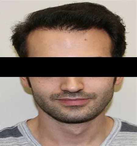 After treatment