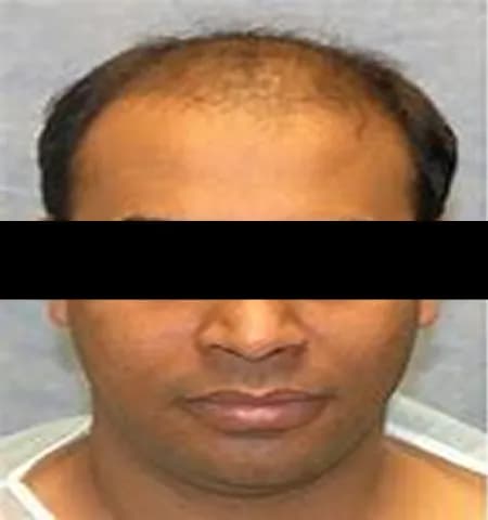Before treatment