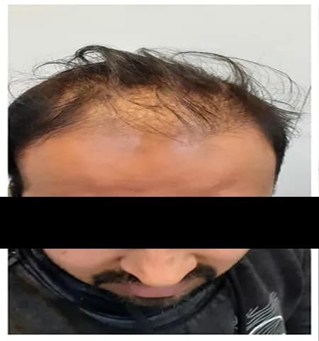 Before treatment