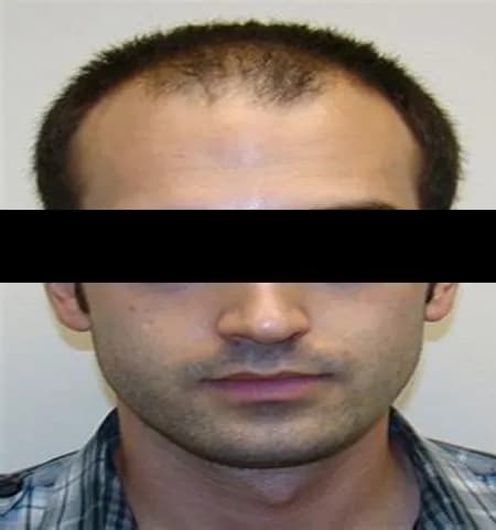 Before treatment