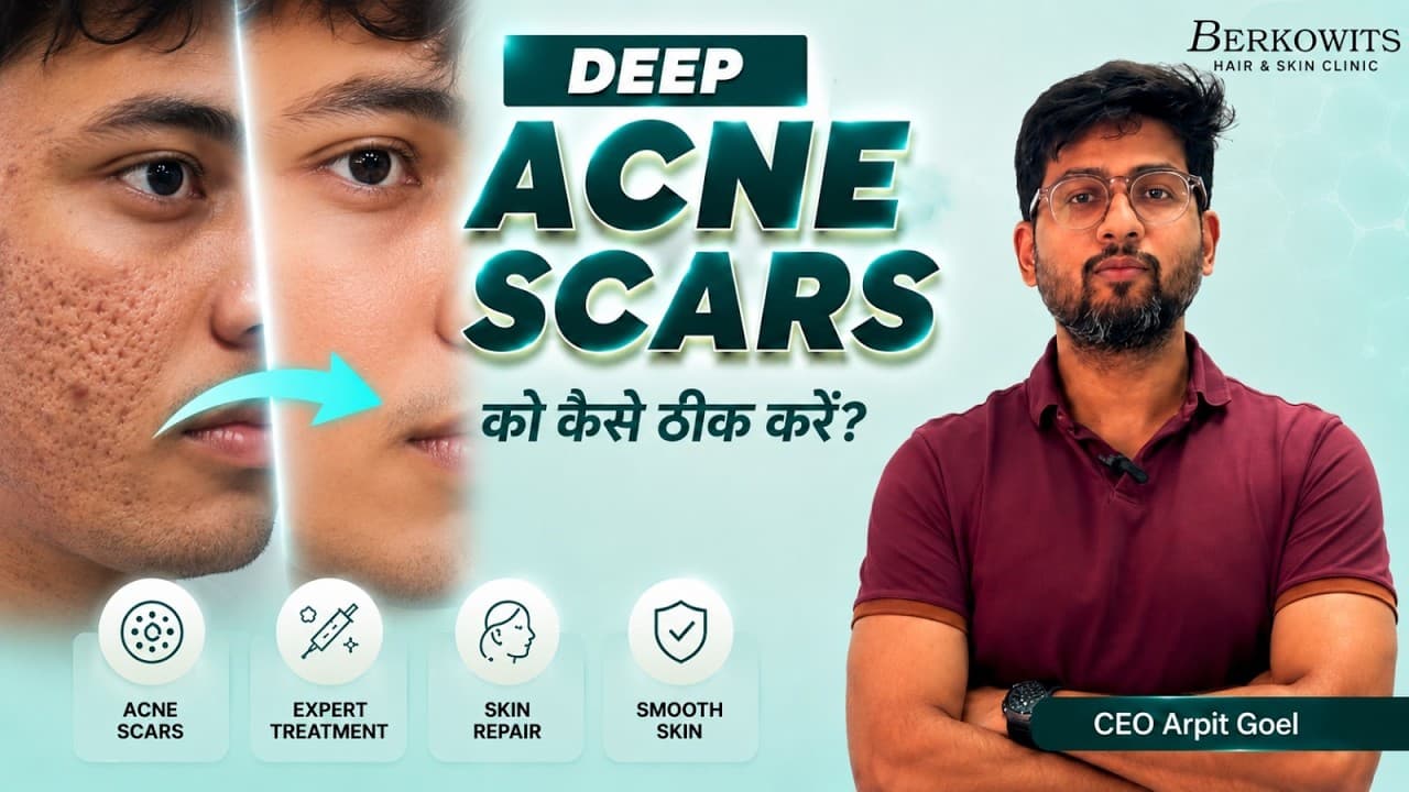 Deep Acne Scars को कैसे ठीक करें? | Best Treatments for Pimple Marks in Men | Berkowits