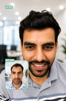 Berkowits Chembur hair transplant before and after result 2