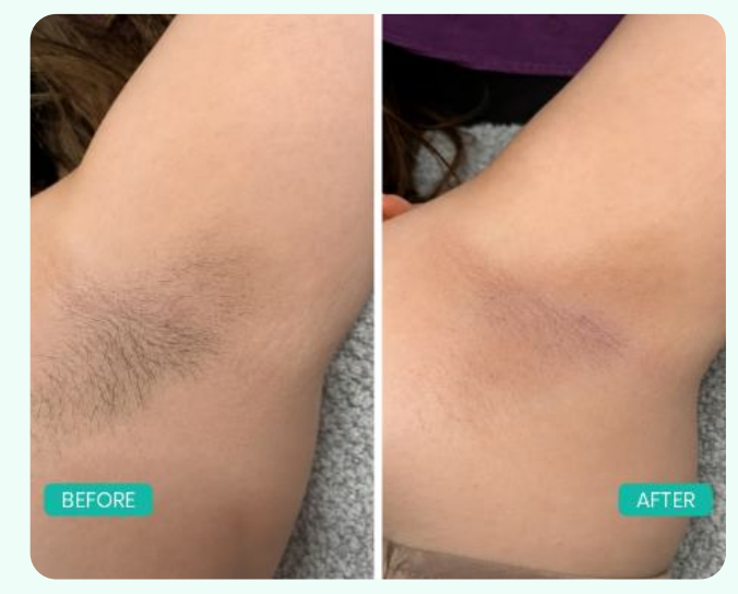 Underarm laser hair reduction before and after result — Berkowits Indiranagar