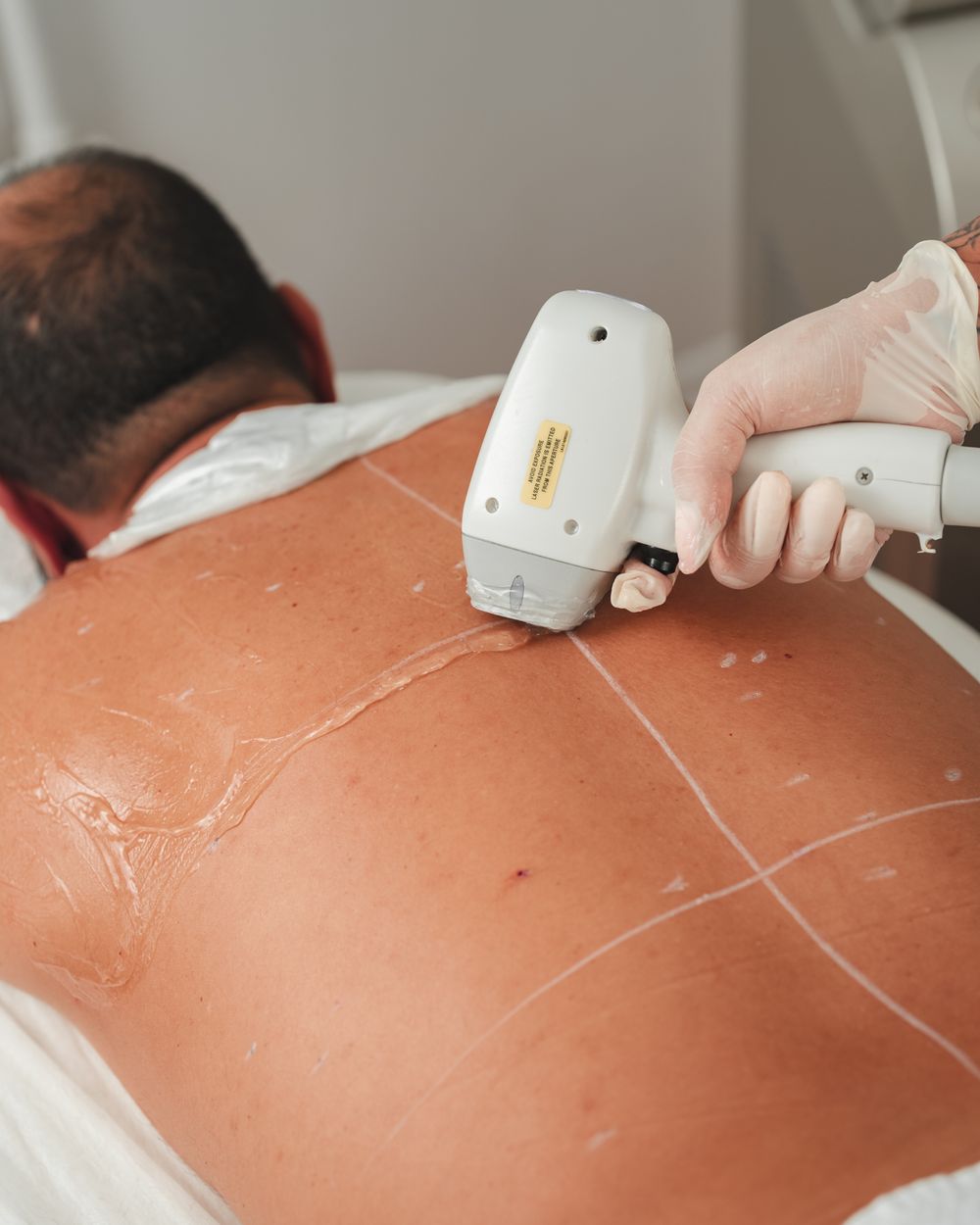Laser hair reduction for men at Berkowits Koramangala